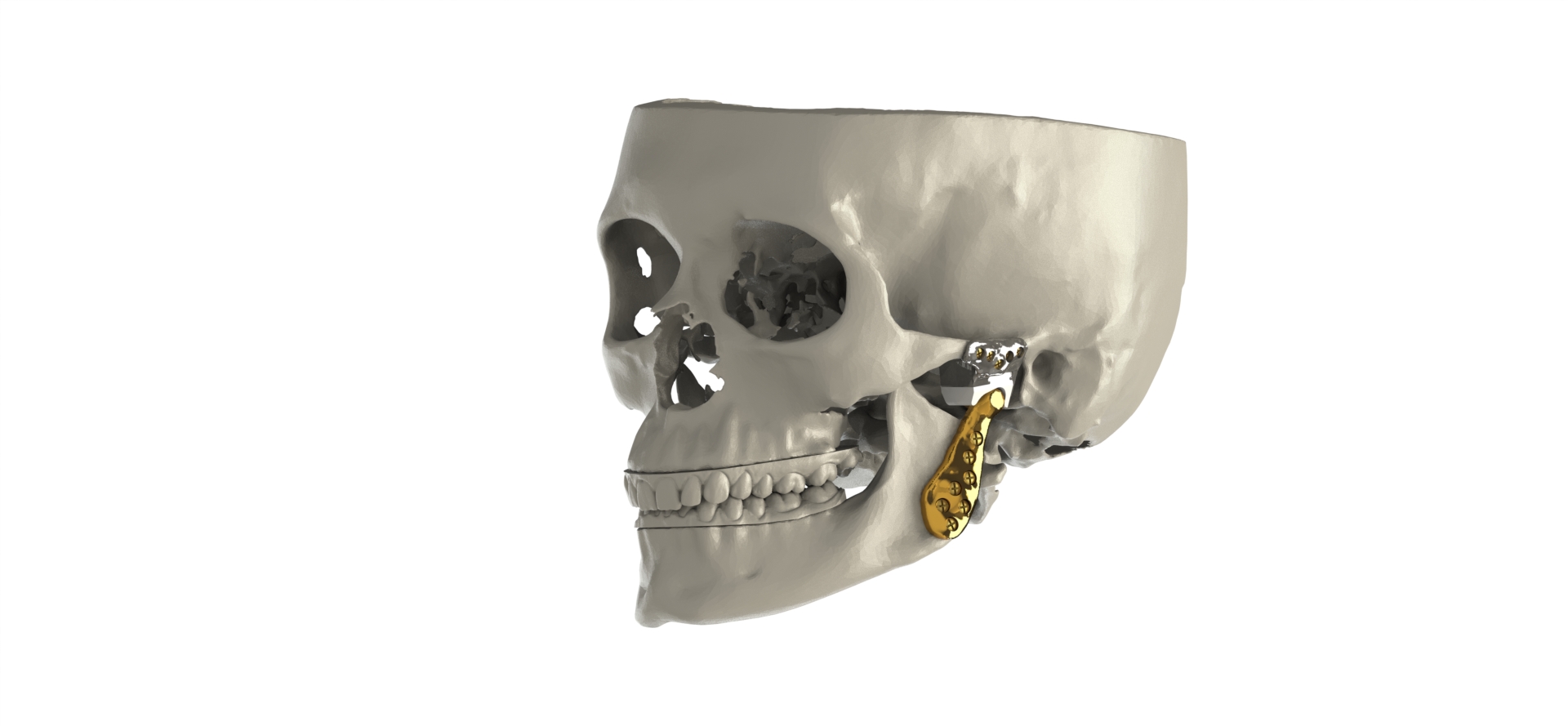 OrthoTin Temporomandibular Joint Replacement System