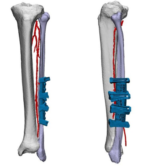 Fibular